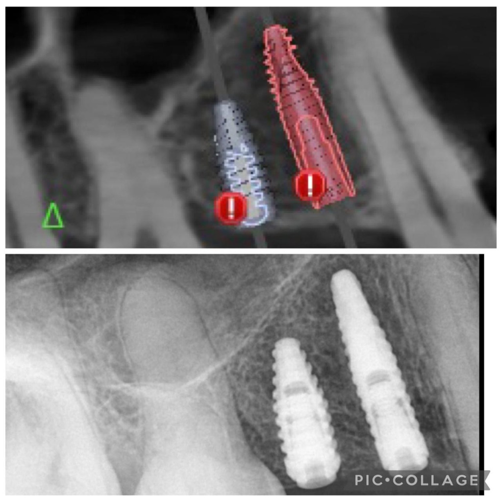 Planejamento Virtual vs Radiografia Pós-Operatória